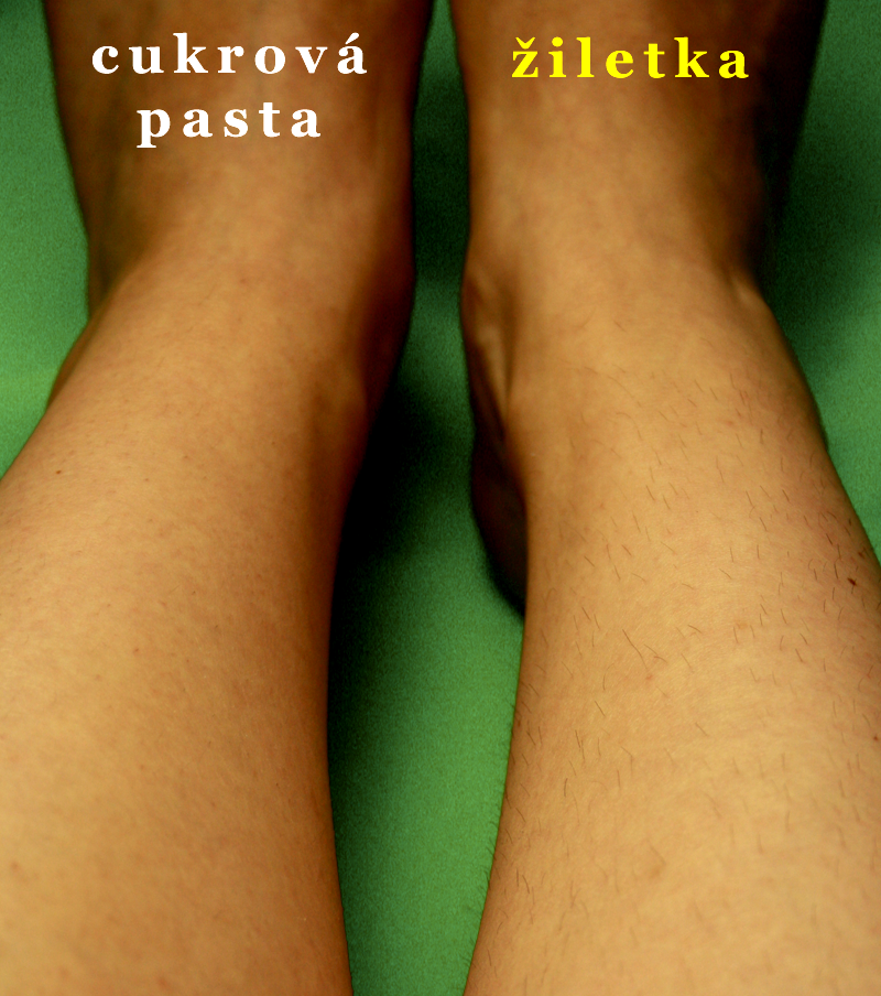 Stav chloupků po 14 dnech od depilace a oholení žiletkou